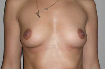 Prothèses mammaires avant Clinique FLC Esthétique à Perpignan